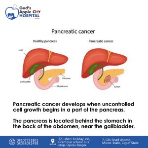 pancreatic cancer