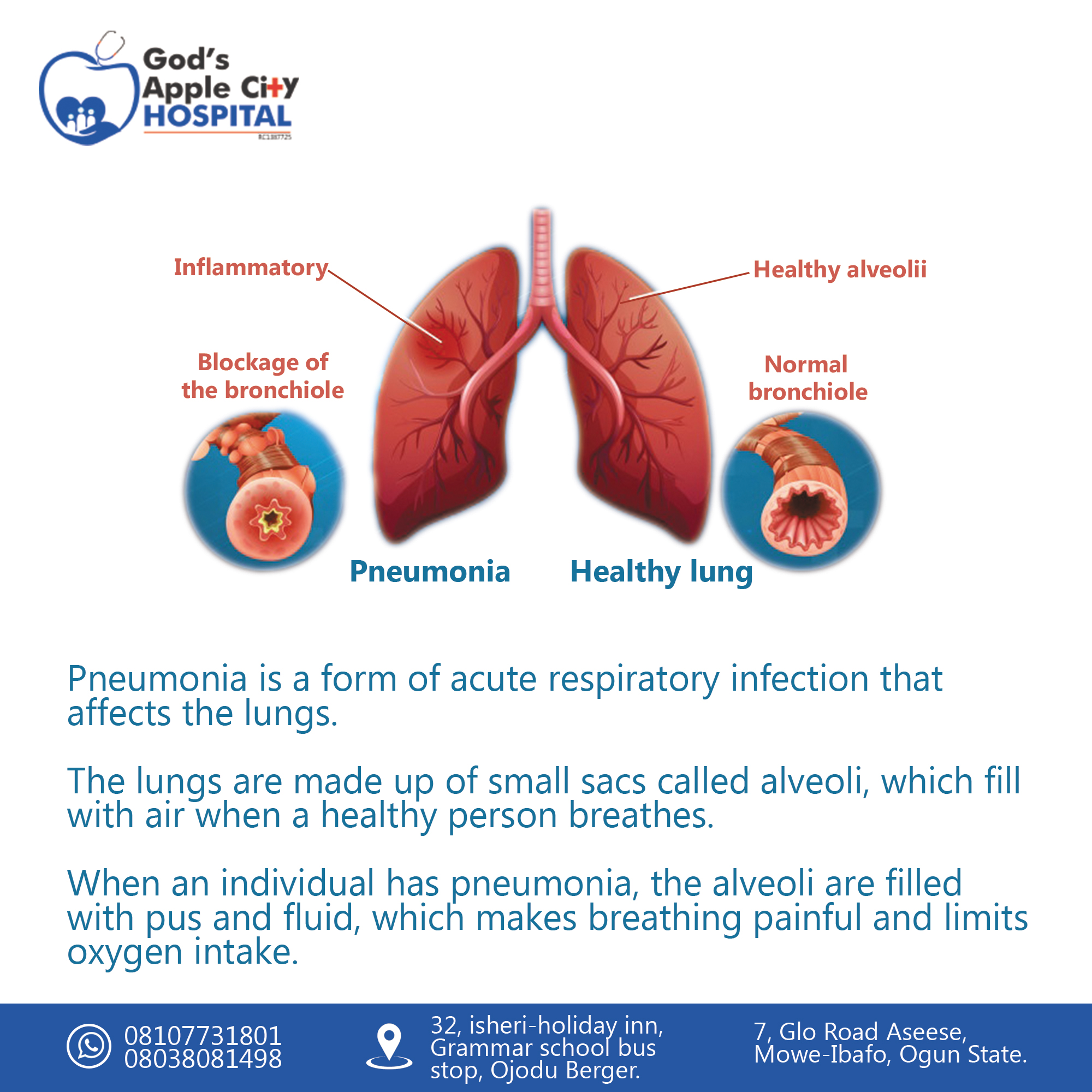 Pneumonia