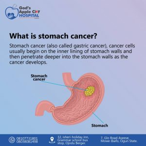 Stomach cancer