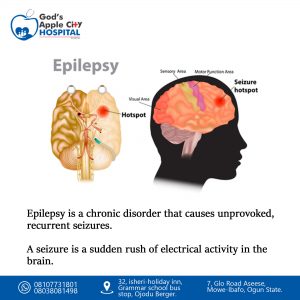 Epilepsy