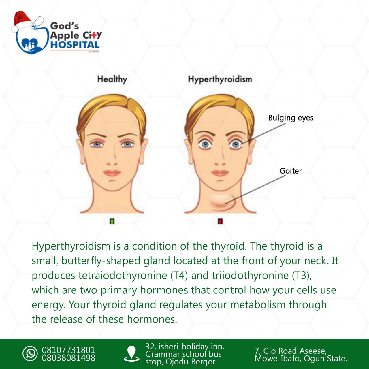 Hyperthyroidism