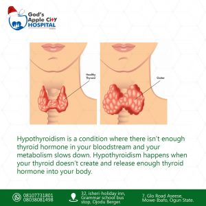 Hypothyroidism