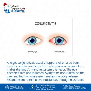 Allergic conjunctivitis 