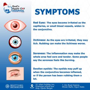 Allergic conjunctivitis 