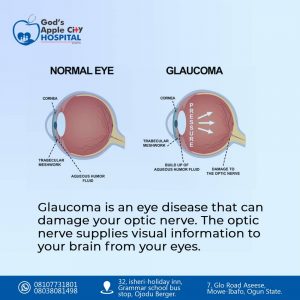 Glaucoma