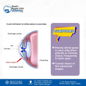 Glaucoma