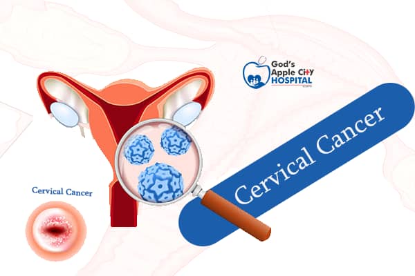 Cervical Cancer