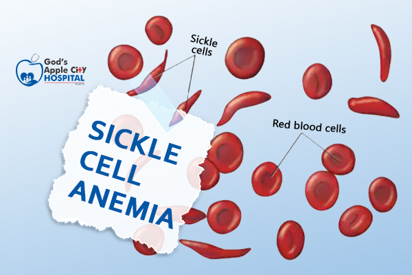 Sickle cell anemia