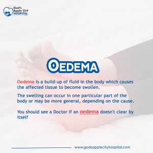 Oedema